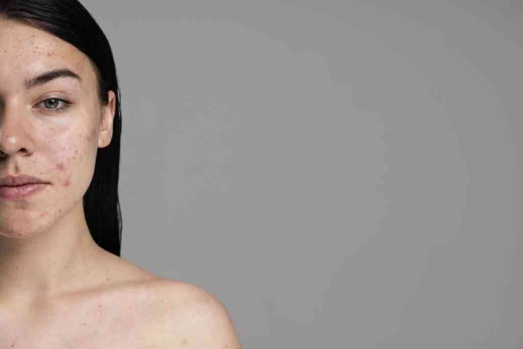 young woman showing her acne with confidence